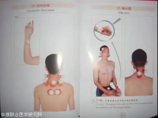 腰部拔罐视频,舒筋活络，体验传统中医养生之道