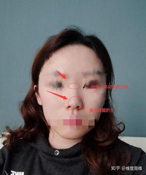 鼻骨内推视频,专业视频带你直观了解