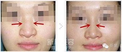 鼻骨内推视频,专业视频带你直观了解