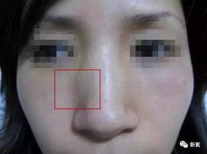鼻骨内推视频,专业视频带你直观了解