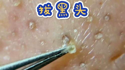 黑头粉刺拔出视频
