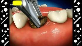 种牙全过程视频,从术前准备到术后恢复的全方位揭秘