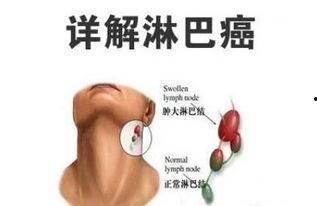 浅表淋巴结触诊视频,视频教学概述