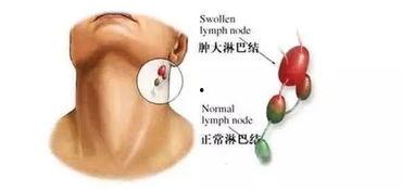 浅表淋巴结触诊视频,视频教学概述